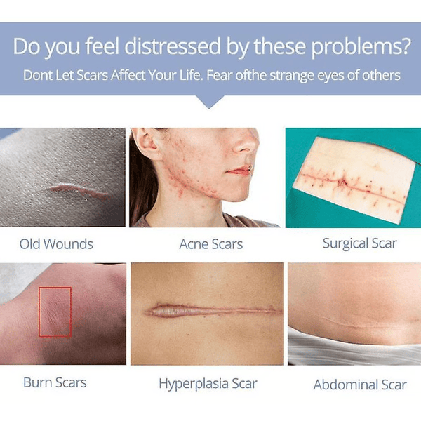 Scar Removal Cream Repair Stretch Marks Burn Acne Surgical Acne Scar Ointment Herbal Treatment Gel