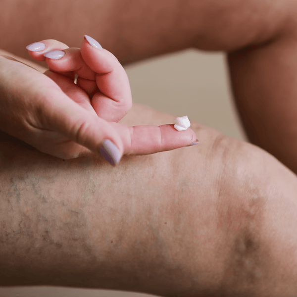 Vein Smoothing Varicoses Veins Cream