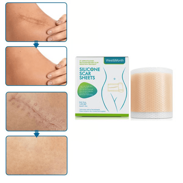 Medical Soft Silicone Gel Tape for Scar Removal – Effective & Safe Scar Treatment