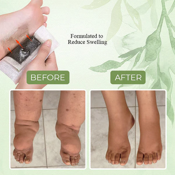 Lymphvity Anti-Swelling Foot Patch – Natural Swelling Relief & Detox