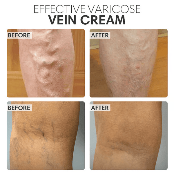 Vein Smoothing Varicoses Veins Cream
