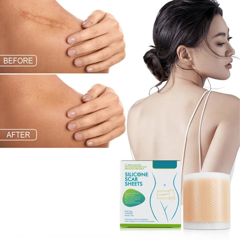 Medical Soft Silicone Gel Tape for Scar Removal – Effective & Safe Scar Treatment