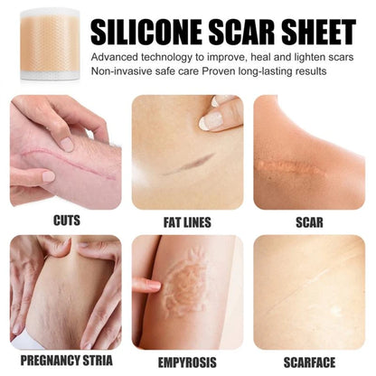 Medical Soft Silicone Gel Tape for Scar Removal – Effective & Safe Scar Treatment